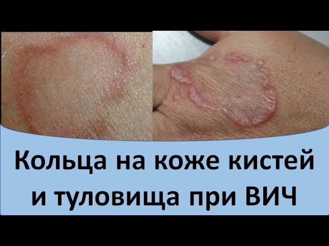 Кольца на коже кистей и туловища  при ВИЧ. Кольцевидная гранулема.