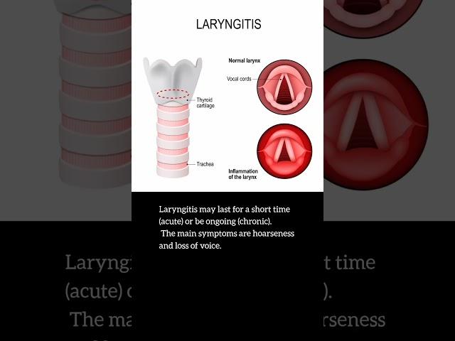 Laryngitis