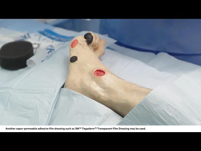 Application tips: 3M™ V.A.C.® Dressing Application Bridging Technique on Foot Wound