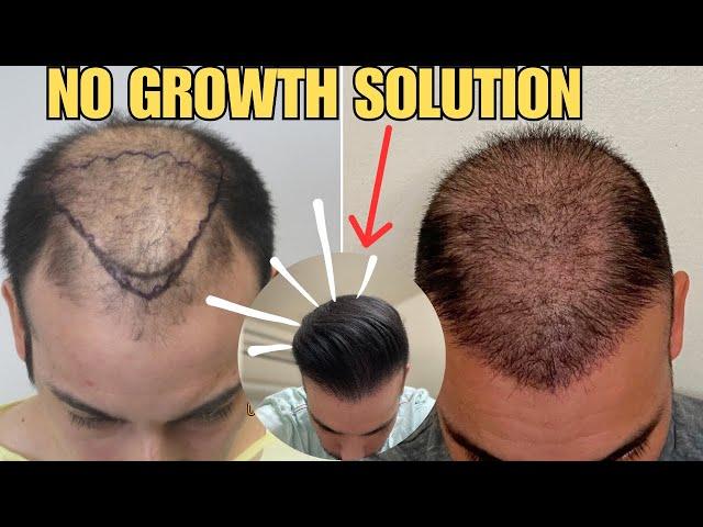 Hair Transplant No Growth- SOLUTION