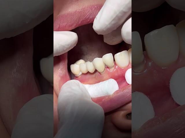 Fixed bridge #dentist #dental
