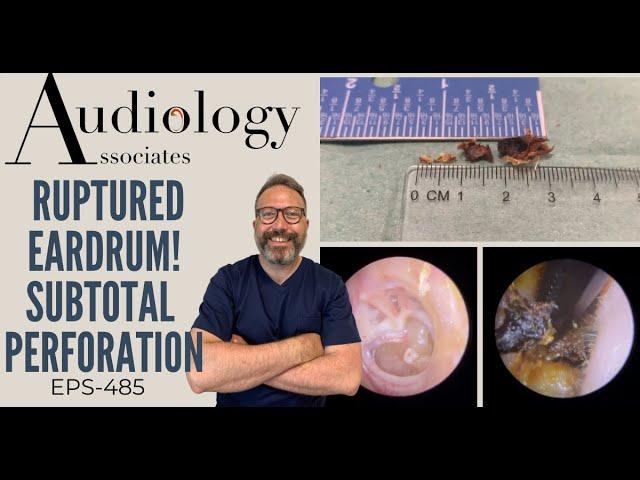 RUPTURED EARDRUM - SUBTOTAL PERFORATION - EP489