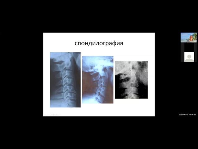 Vertebral diseases of nervous system s