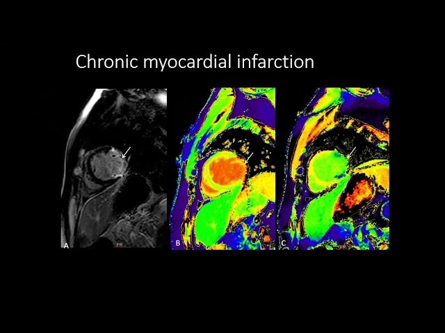 9. CMR Parametric Mapping Dr  Richa Kothari