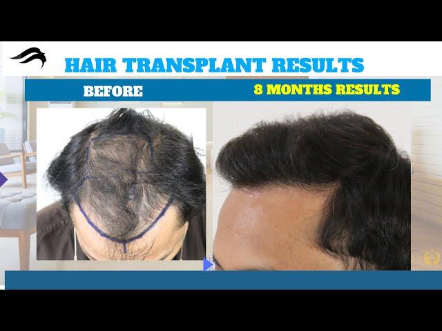 Hair Transplant In Dubai | Best Clinic Surgeon Cost & Center Of Hair Transplant In Dubai