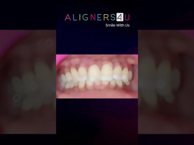 TEETH STRAIGHTENING WITH ALIGNERS4U #shorts #aligners #teeth #dental #invisalign #hyderabad #smile