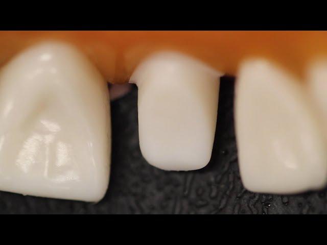 All Ceramic Crown Anterior Tooth Preparation