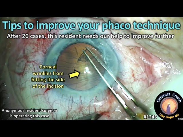 CataractCoach 1245: tips to improve your phaco technique