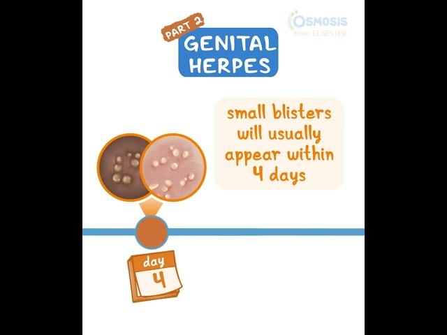 Genital Herpes pt 2