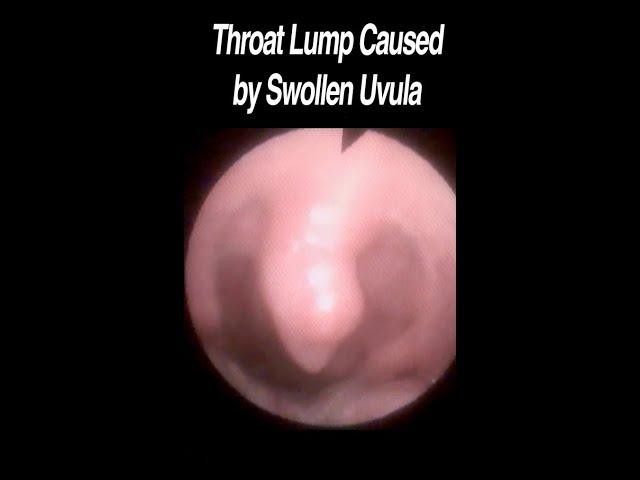 Swollen Uvula Causing Lump Sensation in Throat #shorts #throatlump #globus  @fauquierent