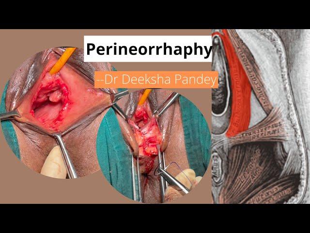 Perineorrhaphy | Step by Step Reconstruction of Perineal Body | Dr Deeksha Pandey