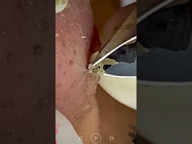 Skincare | Blackheads Removal #491 #tweezers skincare #blackheads blackheads