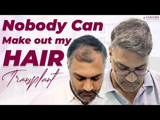 Best Hair Transplant in Ahmedabad | Best Results & Cost of Hair Transplant in Ahmedabad