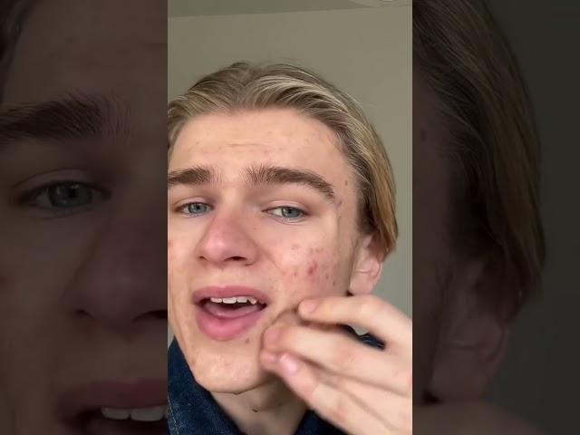 How to cover your acne as a guy