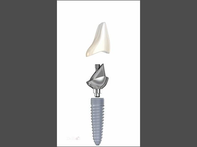 Ceramic Crown & Implant Abutment Anatomy