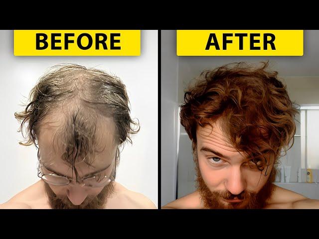 Preventing Balding: What I Did Before It Was Too Late... | Hair Surgeon Reacts