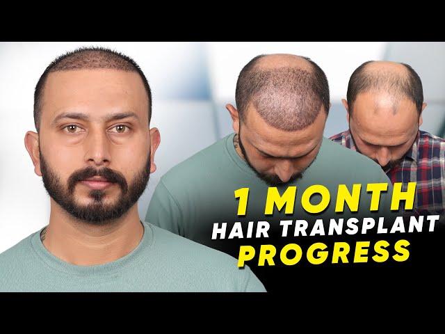 Hair Transplant in Kota | Best Results & Cost of Hair Transplant in Kota