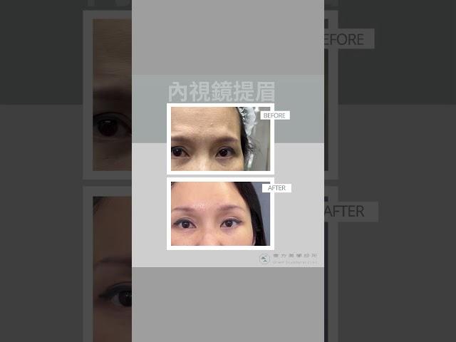 內視鏡提眉 #提眉