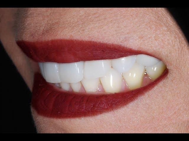 Video Procedure of Placing Dental Veneers with Dental Implant at Cosmetic Dental Associates