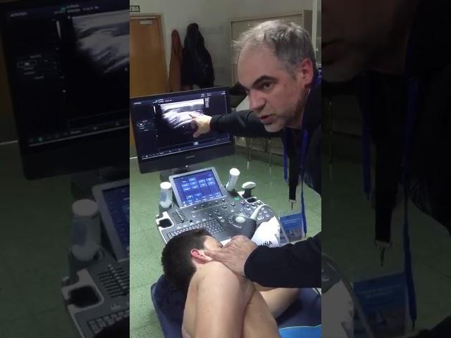 LIFESCANBURSASUBACROMIOSUBDELTOIDEA.DR SERGI BOADA