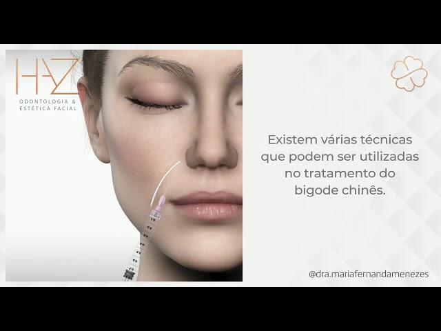 Harmonização Orofacial com Dra Maria Fernanda Menezes - como funciona procedimento bigode chinês