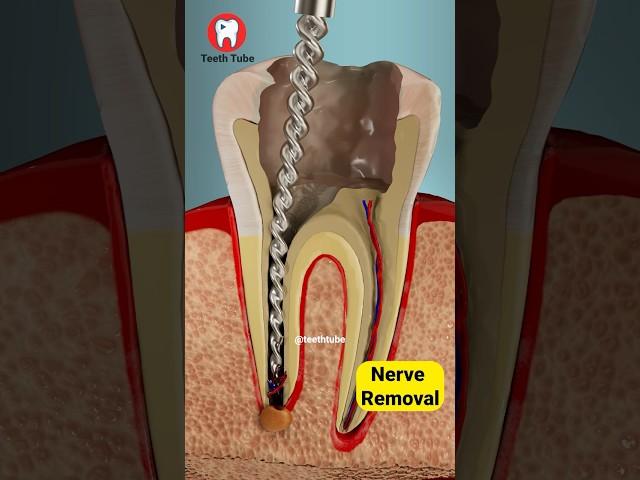 Root Canal Treatment 3D Animation #shorts