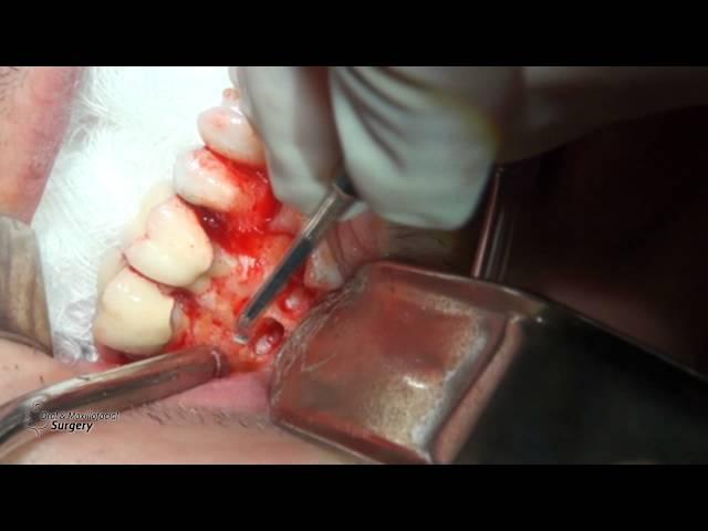 Dental Case 02 - Dr. Alexander V. Antipov