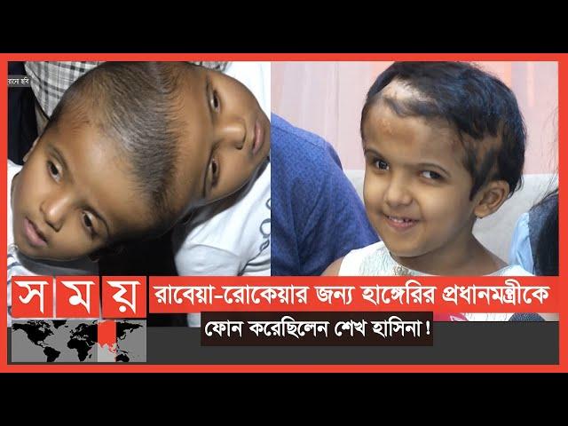 ৪৮ বার অপারেশন শেষে বাড়ি গেলো 'জোড়ামাথার' রাবেয়া-রোকেয়া ! | Conjoined Twins | Somoy TV