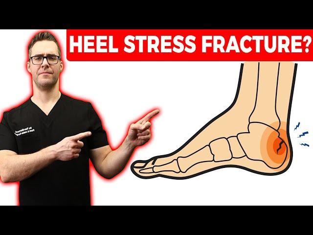 Calcaneus Heel Stress Fracture Treatment [Squeeze Test & Recovery!]