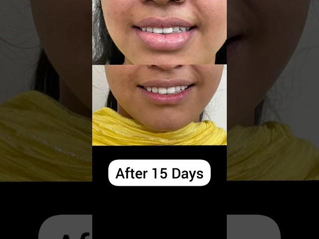 Lip Reduction surgery | Step by step | 15 Days Result