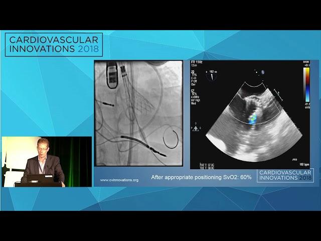 CVI2018 Session: My most humbling TAVR case - Alan Zajarias, MD