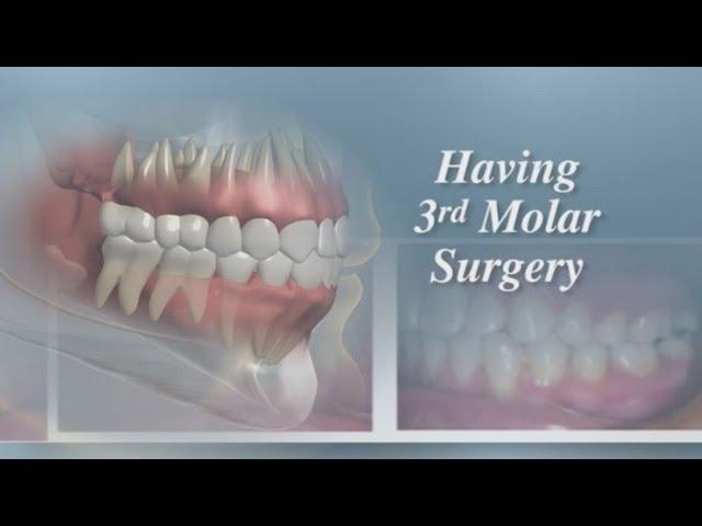 Having Third Molar Surgery