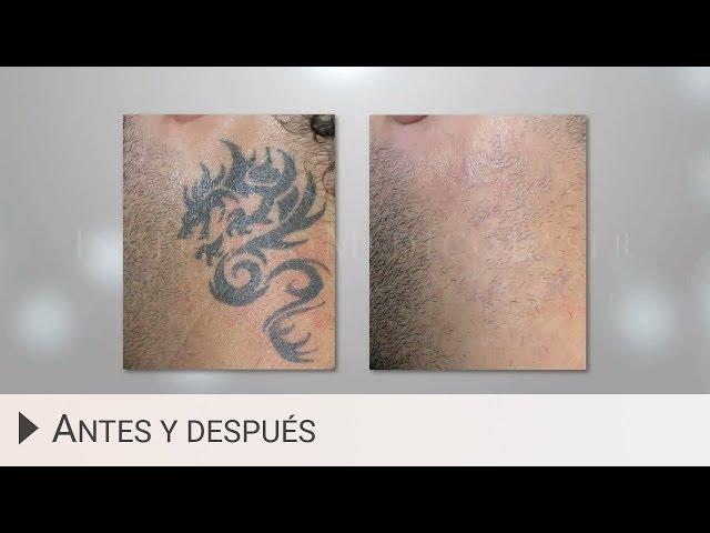 Eliminar tatuajes con láser - Antes y después