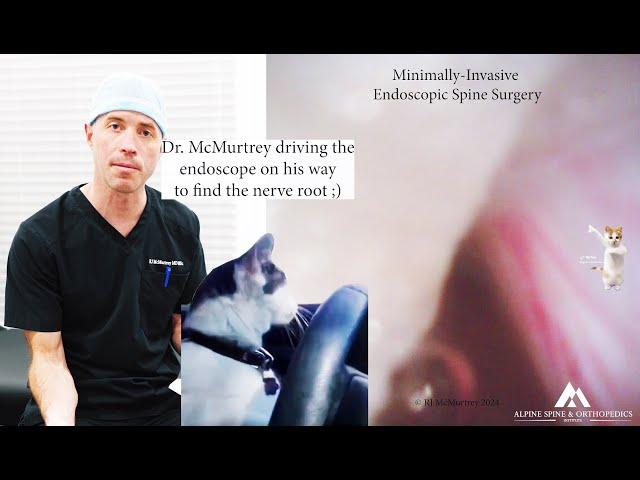 Endoscopic Spine Surgery: Minimally-Invasive Nerve Root Release & Repair