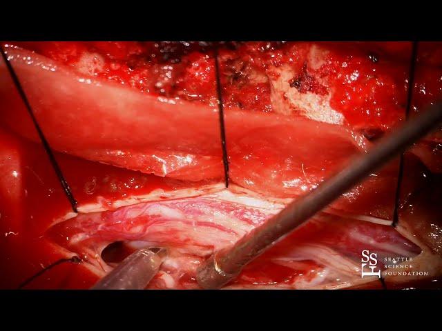 Live Surgery: Resection of Spinal Tumor - Rod J. Oskouian, M.D.