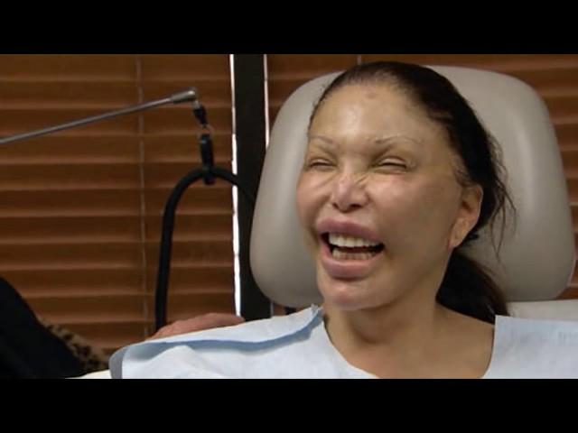 10 Worst Cases Of Plastic Surgery Gone Wrong