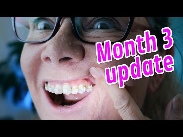 Month 3 Adult Braces Update MOVING TEETH!