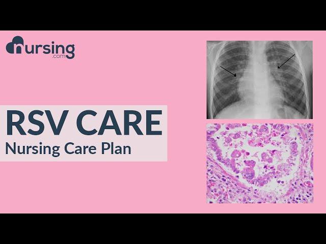 How to Diagnose Bronchiolitis or Respiratory Syncytial Virus (RSV).. Nursing Care Plan