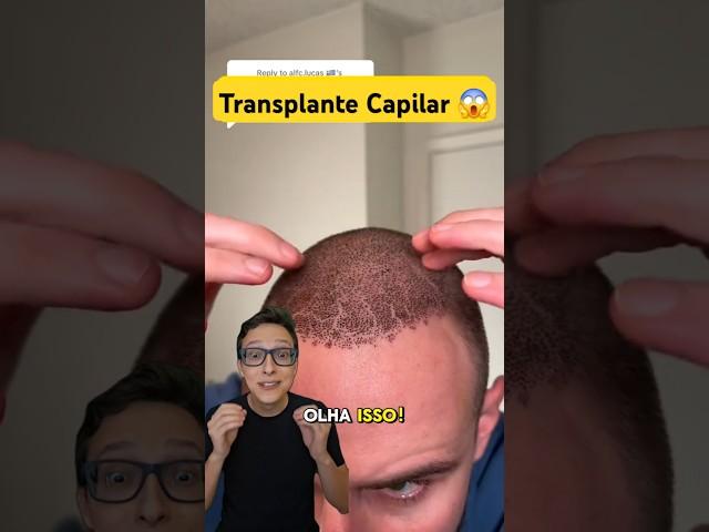 Transplante Capilar #medicina #medico #enfermagem #enfermeiro #enfermeira Antes e Depois Implante