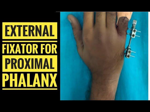 External Fixator/ JESS Fixator Application for Phalanx Fracture