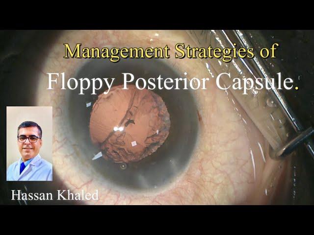 Management Strategies of  Floppy Posterior Capsule