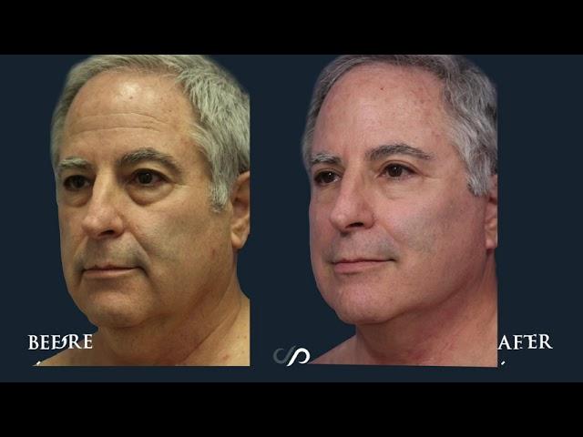 Traceless Facelift On a 64 Year-old Doctor | Before and After | Dr. David Stoker