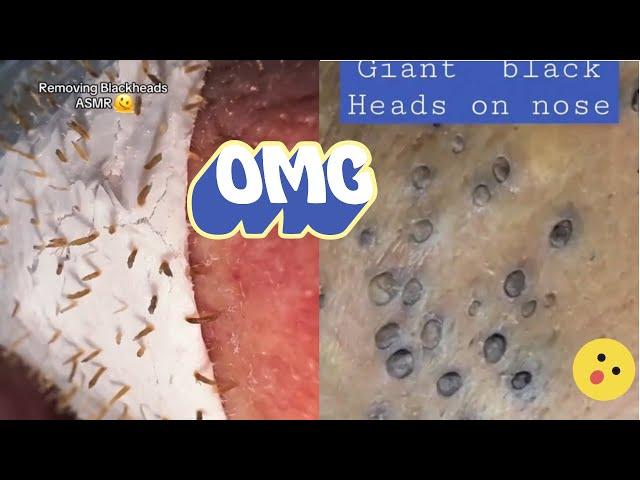 Pimple Paradise: A Deep Dive into Blackhead Extraction