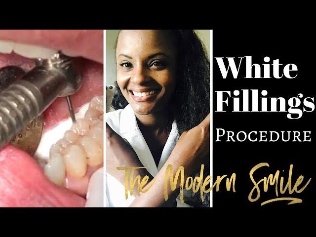 White (Composite) Fillings Dental Procedure