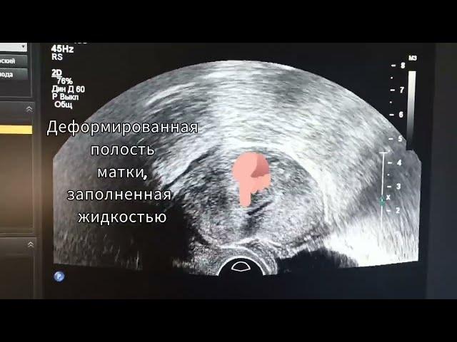 рубец с деформацией полости матки. deformity of the uterine cavity