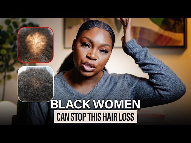 What's the REAL Reason Behind Hair Loss in Black Women?