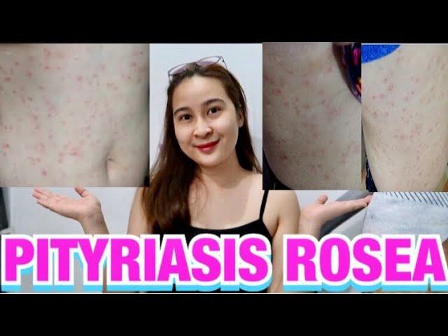 PITYRIASIS ROSEA  (DAPAT at HINDI DAPAT GAWIN) MY SKIN STORYPHILIPPINES