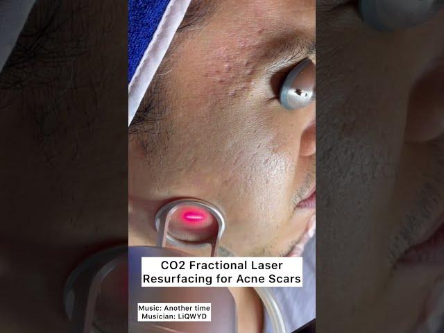 CO2 Fractional Laser Resurfacing for Acne Scars #shorts