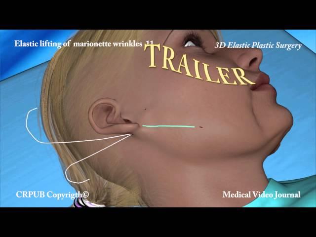 3D Elastic lifting of marionette wrinkles  11