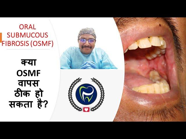 Dr Rudra Mohan | is OSMF reversible ? क्या OSMF वापस ठीक हो सकता है? Oral Submucous Fibrosis